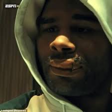 See a doctor for a cut on the lip if: Ufc Star Alistair Overeem Shows Off His Stitches After Having Torn Lip Surgically Repaired Daily Mail Online