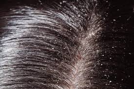 Hair, like everything else, has a natural ph range—aka a level of acidity or alkalinity—to maintain in order some hair (and skin) types may not be suitable for acv at all. 70 Wonderful Uses Of White Vinegar