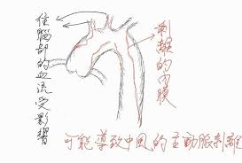 For faster navigation, this iframe is preloading the wikiwand page for 主動脈剝離. æ­¡è¿Žå…‰è‡¨äºžæ±ç´€å¿µé†«é™¢