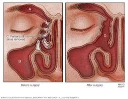 Endoscopic Sinus Surgery Chronic Sinusitis Sinus Surgery Sinusitis
