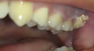 You will likely only be using gauze for several hours after your surgery. Gauze Stuck In Near Wisdom Tooth Extraction Dentistry