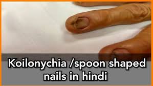 Image result for Koilonychia feet