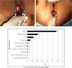 Cervical Erosion As Result Of Infectious Vaginitis Semantic Scholar