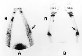 Image result for Osteomyelitis Bone Scan