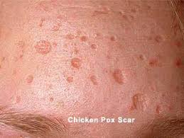 Schada Beauty Spa Rawatan Untuk Menghilangkan Parut Chicken Pox Di Wajah
