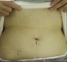 Maybe you would like to learn more about one of these? Scarless Surgery For A Huge Liver Cyst A Case Report Sciencedirect