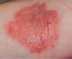 It can cause pain, burning, or itching, and it may be warm to the touch. What Is Causing The Rash On This Woman S Inner Elbow Consultant360