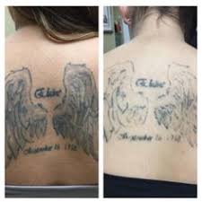 How soon will i see results with picoway? 9 Picoway Tattoo Removal Ideas Tattoo Removal Laser Tattoo Laser Tattoo Removal