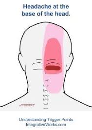 Headache At The Base Of Your Head Integrative Works Headache Treatment Natural Headache Remedies Trigger Points