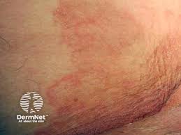 Image result for sore skin in the groin area