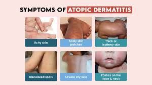 Image result for Atopic Dermatitis