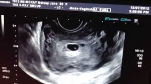 6 week ultrasound twins' pictures. 6 Week Pregnancy Ultrasound Small Sac Youtube