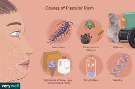 Pustular Rash: Treatment For Acne, Psoriasis, And More