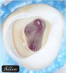 Vital pulp therapy - Style Italiano Endodontics