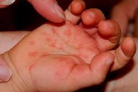 Bintiknya tu kecil tapi agak perih jg kalo disentuh , ga gatel. Bintik Merah Di Telapak Tangan Penyebab Gejala Diagnosis Pengobatan Kompeten Tentang Kesehatan Di Ilive