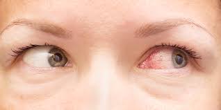 Conjunctivitis Pink Eye Aoa