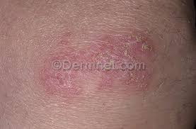 Image result for Eczema nummulare
