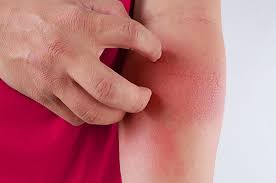 Kulit terasa kasar dan tampak tidak rata. Pria Dan Wanita Waspadai Tanda Psoriasis Ini