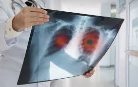 Image result for lung cancer xray