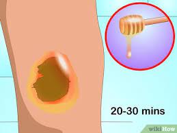 Avoid cotton swabs, as the honey may pick up the small fibers and deposit them on the scab. 4 Ways To Get Rid Of Acne Scabs Fast Wikihow