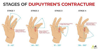 All You Need To Know About Dupuytren S Contracture Dupuytren S Contracture Med School Motivation Trigger Finger