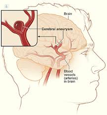 Aneurisma aortico (aneurisma dell'aorta toracica; Aneurisma Cerebral Que Es Sintomas Causas Prevencion Y Tratamiento Top Doctors