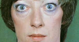 Exophthalmus is a genus of broadnosed weevils in the family curculionidae selected species distribution references exophthalmus agrestis exophthalmus albidu. Hervortretende Augen Exophthalmus Glubschaugen Was Das Symptom Bedeutet Augen Glubschaugen Umschau