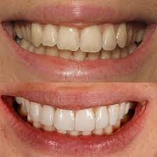 However, some factors may influence the tooth filling cost. Composite Veneers Your Guide To Teeth Bonding Transformations Glamour Uk