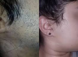 Face laser hair removal cost differs from one person to another, and it prices about $400 to $700. Laser Hair Removal Full Body Laser Hair Removal