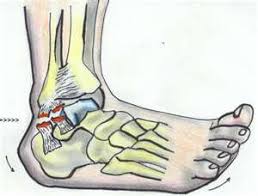 How is a tendon or ligament made? Torn Ligaments In Ankle Swelling And Bruising Pictures And How To Heal A Sprained Ankle Sprained Ankle Ankle Ligaments Ligament Tear