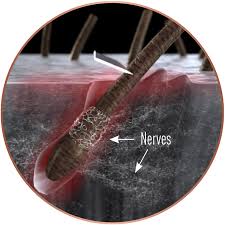 Many hairs in one follicle may appear on your scalp, underarms, pubic area on legs especially after shaving, waxing. Beard Growth Science Stages Of Beard Growth Gillette