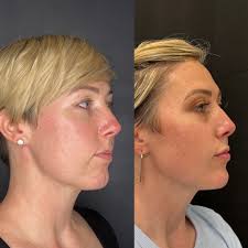 Main reason I wanted to contact you guys is that I'm having an event this  Friday 5/20 all day where we are offering Restylane for $350/ syringe. We  have another doctor Dr.