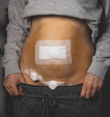 Normalerweise kann man nach ein bis zwei tagen wieder duschen, jedoch dürfen die wunden nicht eingeseift werden und müssen danach behutsam trocken getupft werden. Endometriose Uber Symptome Und Behandlungen Cuca By Linda
