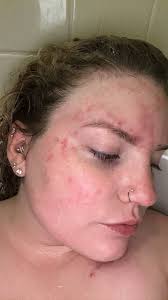 What supplements have caused your stomach to feel like it's burning? When I  add collagen powder to my smoothies my stomach feels like it's