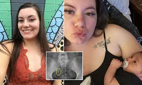 I knew it was still inside me': Doctors 'lost' contraceptive coil inside  29-year-old mum-of-one... until a chance X-ray 12 years later revealed it  was lodged in her bottom