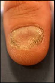 Image result for Koilonychia feet