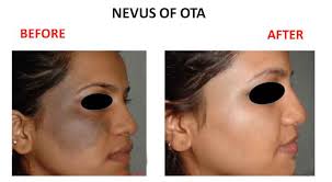 Nevus Of Ota Amrit Clinic