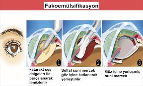 Katarakt, birçok kişinin karşılaştığı sağlık sorunları arasında yer alıyor. Katarakt Ameliyati Fiyatlari Prof Dr Gokhan Gulkilik