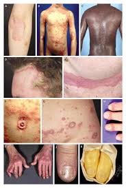 Image result for psoriasis