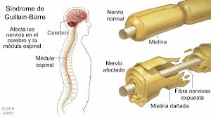 Cuando la capacidad vital es < 15 ml/kg, está indicada la intubación endotraqueal. Sindrome De Guillain Barre Informacion De Interes Sobre Diversidad Funcional Salud Y Bienestar