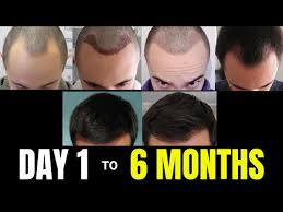 6 Months Evolution Best Hair Transplant Hair Transplant Hair Transplant Results