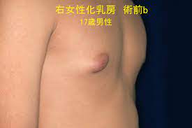 女性化乳房 その２ - Dr中村症例画像集