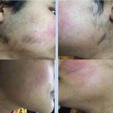 You can expect to see a noticeable reduction in body hair after only a few treatments. Pdf Laser Treatment Of Hirsutism