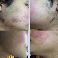 During laser hair removal, a laser emits a light that is absorbed by the pigment (melanin) in the hair. Pdf Laser Treatment Of Hirsutism