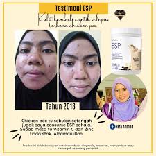Hilangkan Parut Di Muka Dengan Set Kecantikan Shaklee Shima Jelani Pengedar Shaklee Shah Alam