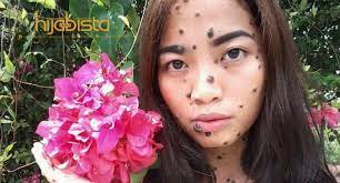 Tahi lalat (nevus pigmentosus) merupakan tumor jinak pada kulit yang paling umum dijumpai pada manusia. Hukum Menghilangkan Tahi Lalat Menurut Islam Amalkan Cara Alami Dijamin Selamat Hijabista
