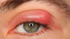 как лечить ячмень на нижнем веке в домашних условиях Chto Takoe Blefarit Iz Za Chego On Voznikaet I Kak Lechitsya