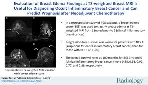 Maintaining a high volume of examinations in dedicated centers definitely impacts positively on experience in interpretation. Evaluation Of Breast Edema Findings At T2 Weighted Breast Mri Is Useful For Diagnosing Occult Inflammatory Breast Cancer And Can Predict Prognosis After Neoadjuvant Chemotherapy Researcher An App For Academics