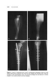 Internal Fixation