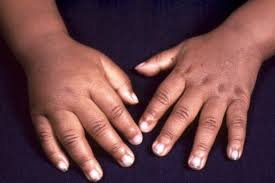 Image result for Dactylitis